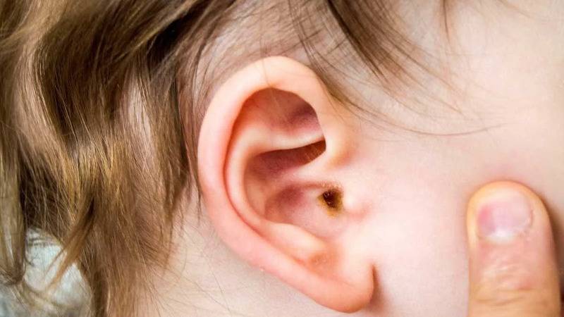 uzmani uyardi orta kulak iltihabi cocuklarda gecici isitme kaybina neden olabilir p5dwhMYf
